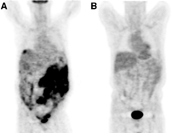 FDG-PET scans of a patient with metastatic GIST prior to and 1 month after imatinib therapy. (A): Coronal fluo- rine-18-fluorodeoxyglucose positron emission tomography ( 18 FDG-PET) scan in a patient with a gastrointestinal stromal tumor metastatic to the abdomen, mesentery, peritoneum, and liver shows intense glycolytic activity in all tumor sites at baseline prior to initiating imatinib. (B): A restaging 18 FDG-PET scan 1 month after initiating imatinib therapy shows complete resolution of abnormal 18 FDG uptake in all tumor sites and no evidence of metabolically active disease, consistent with response to therapy.