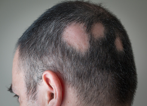 Homem com alopecia areata