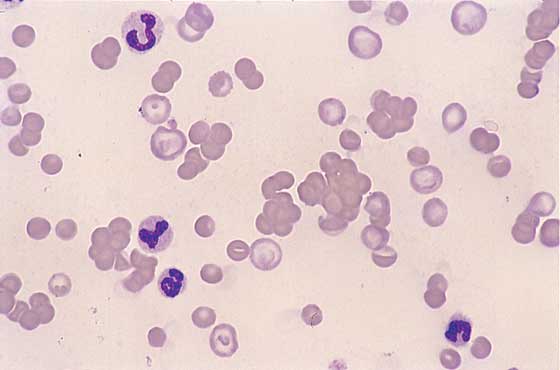 RBC agglutination. Clustering of RBCs in variable groups indicates that agglutination is present. This change is caused by antibody bridging between adjacent RBCs (60x).