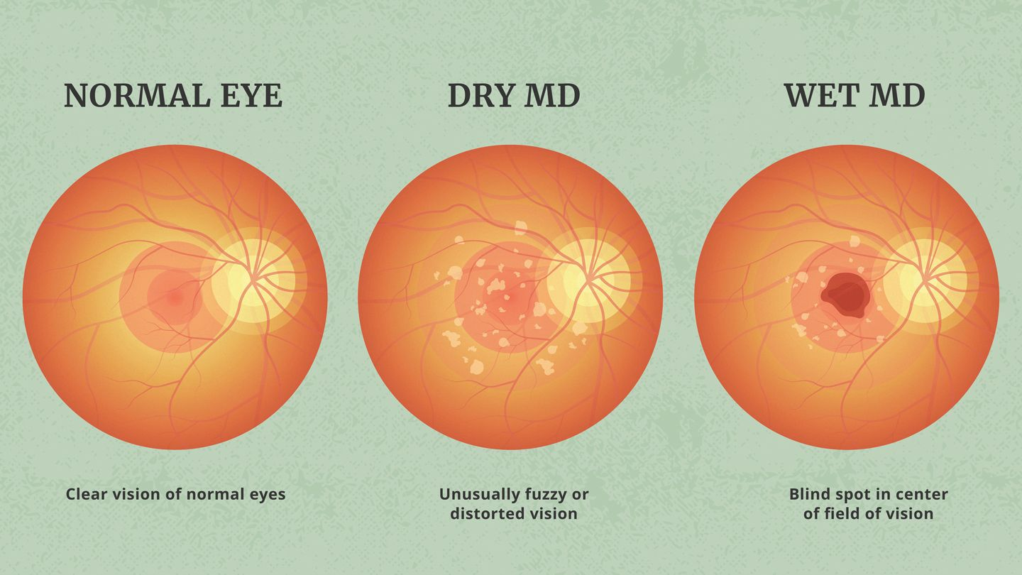 Dry vs Wet AMD