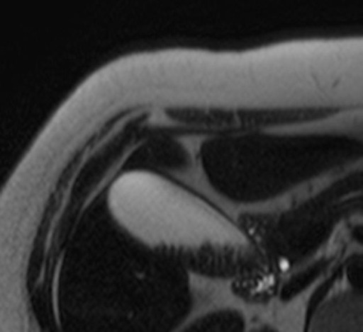 Corte axial de ressonância magnética ponderado em T2, mostrando a vesícula biliar com cálculos depositados no interior. 