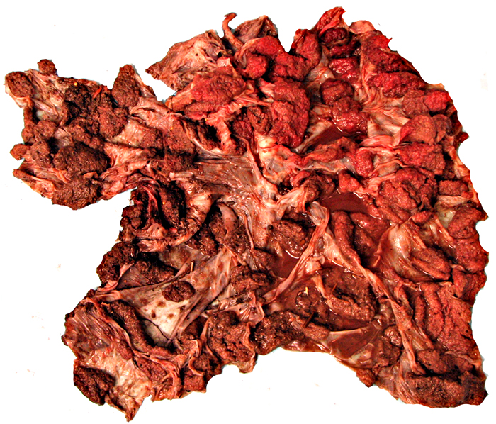 Macroscopic appearance of disrupted cotyledonary placenta.