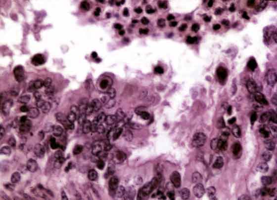 Histopathology of necrotising bronchiolitis associated with adenoviral infection in a foal.