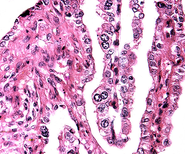 Longitudinal villus with obvious binucleate cells in endometrial glandular space