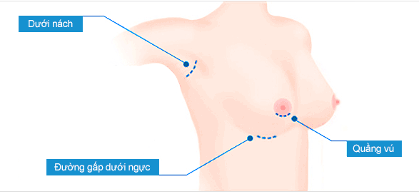 Thời gian nâng ngực nhanh hay chậm còn phụ thuộc vào vị trí mổ mà bác sĩ để túi ngực vào hay còn gọi là đường mổ