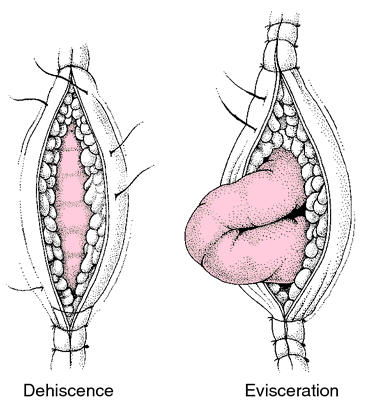 Dehiscence | definition of dehiscence by Medical dictionary