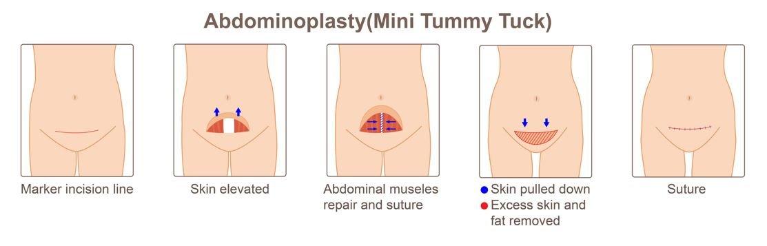 What Is Mini Tummy Tuck And Who Can opt For It?