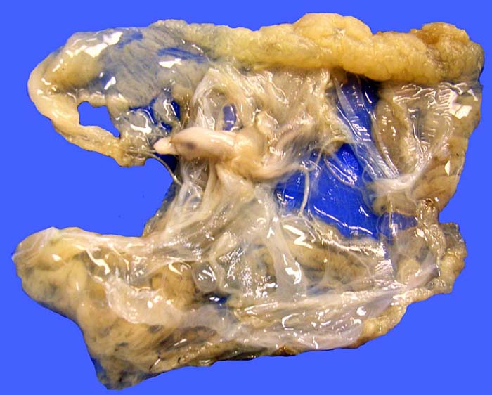 Gross appearance of the formalin-fixed placenta with centrally located umbilical cord.