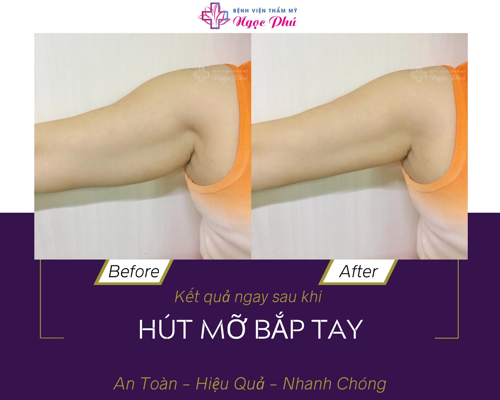 Hút mỡ cánh tay là giải pháp giúp cánh tay thon gọn