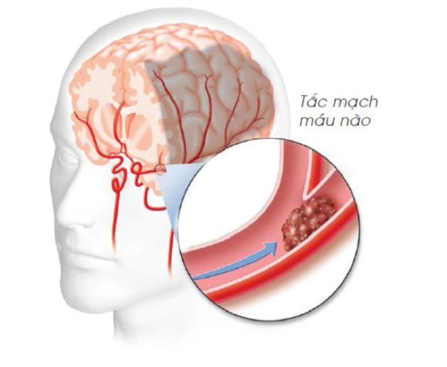 dược phẩm ngừa đột quỵ 
