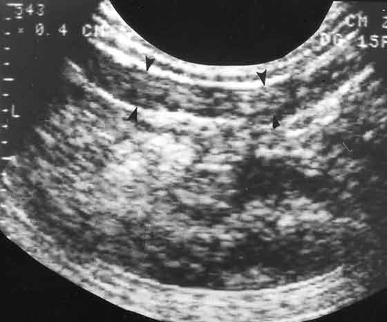 Posparto 15 semanas involución uterina
