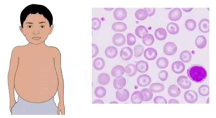 Symptoms of Thalassemia
