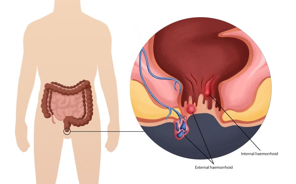 Los síntomas del cáncer anal