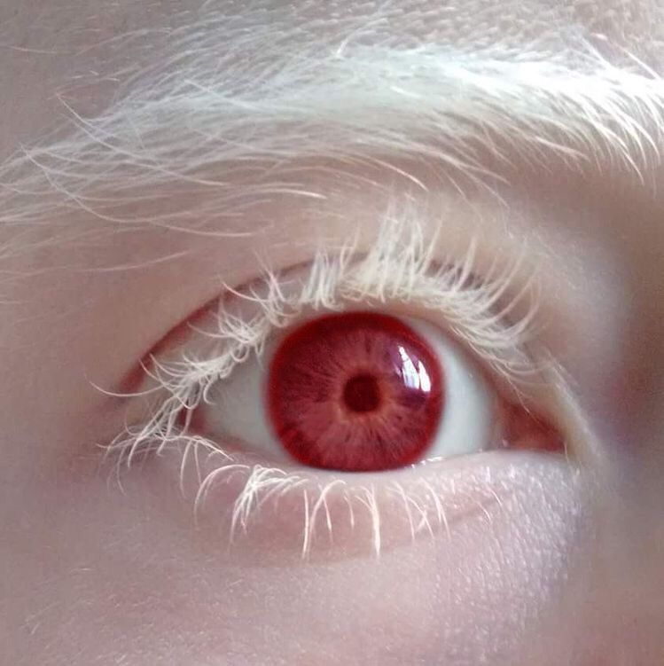 Albinism And The Eyes Arizona Retina Project