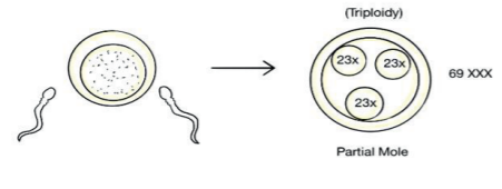 Pathogenesis of molar pregnancy  