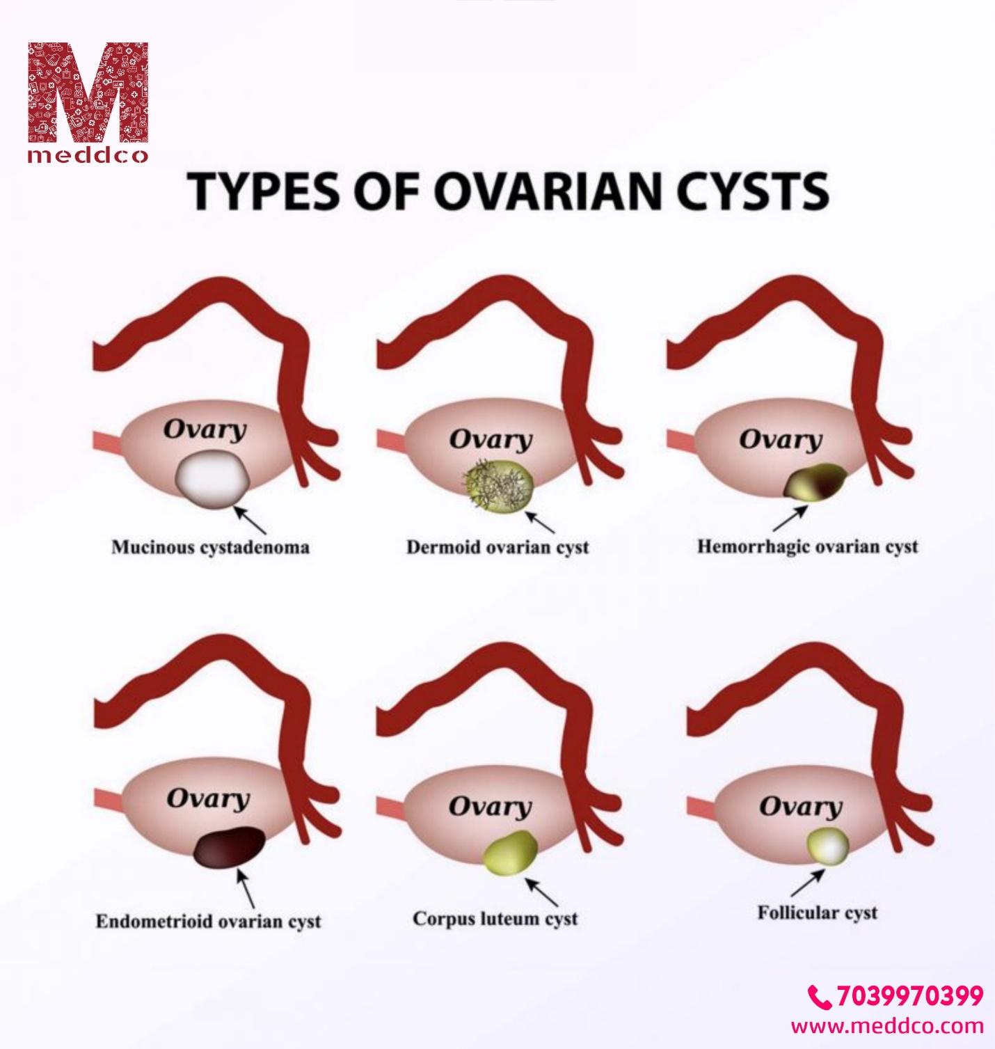 C:\Users\anmol\Downloads\types of ovarian cysts.jpg