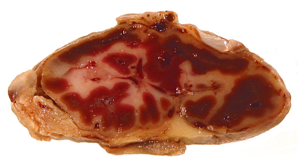 Cross section of fixed placenta; maternal aspect below. The white streaks through the darker labyrinth represent the trophospongium. The placenta consists of many lobules.