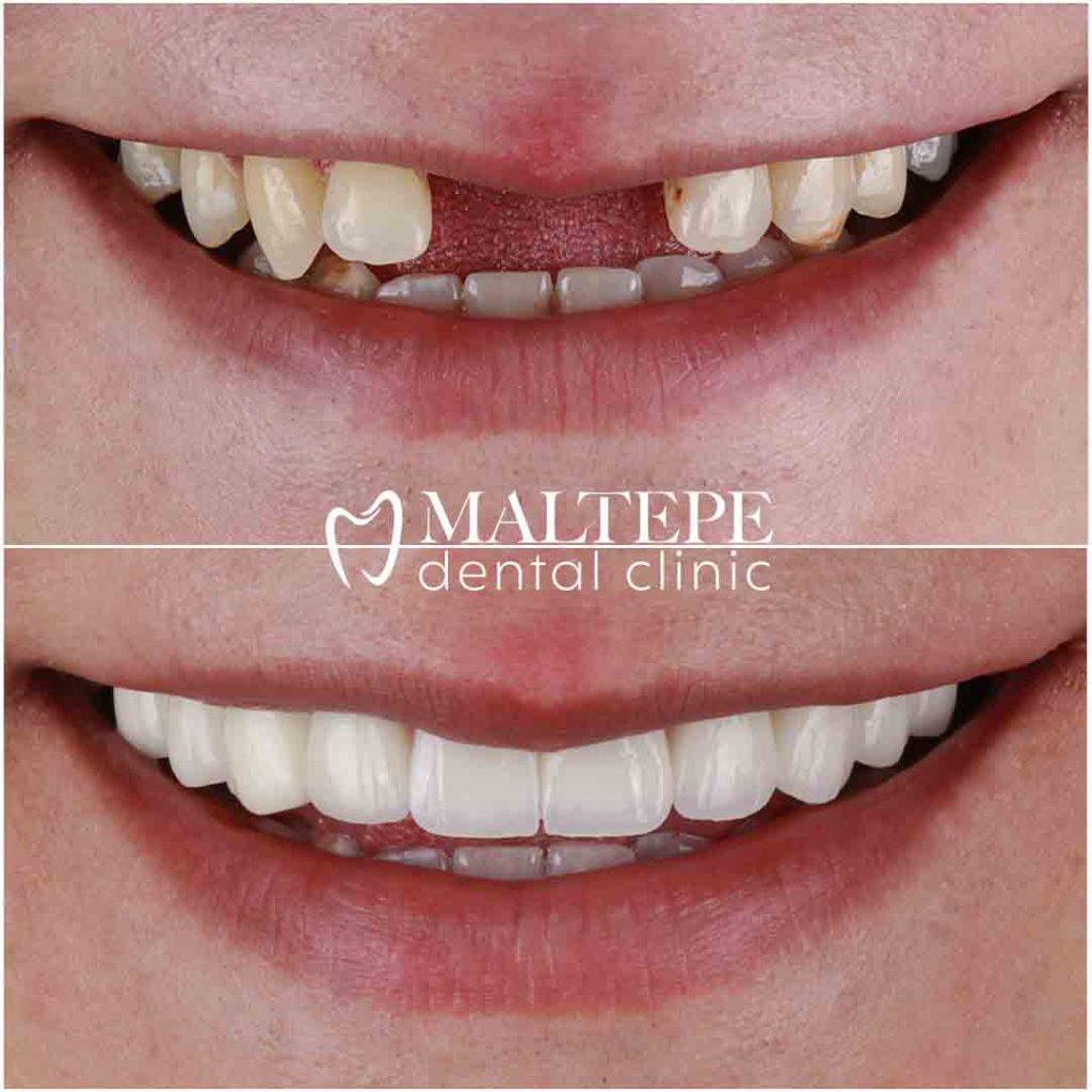 dental bridge before after image