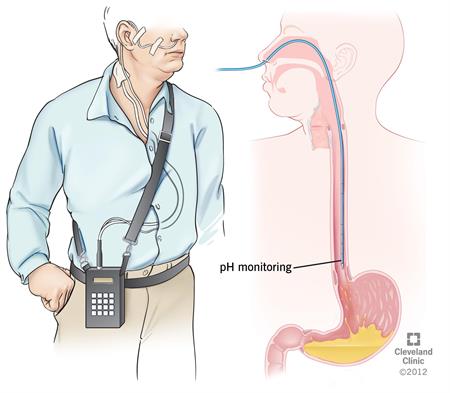 PH Monitoring | Cleveland Clinic