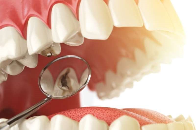 Hàn răng khi sâu răng xuất hiện những lỗ sâu sẫm màu 
