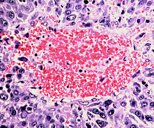 Higher magnification of previous photo to show the complete replacement by trophoblast of the muscular wall and endothelium in a maternal mesometrial blood vessel.