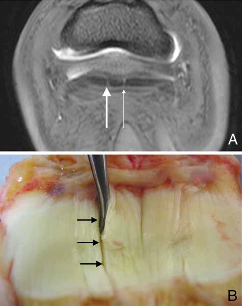 (A) Detail of transverse 3-D T2*-GRE image at the level of the proximal border of the NB of a lame right foot. 
(B) Frontal view of the DDFT at the level of the navicular bursa in the same foot as A.