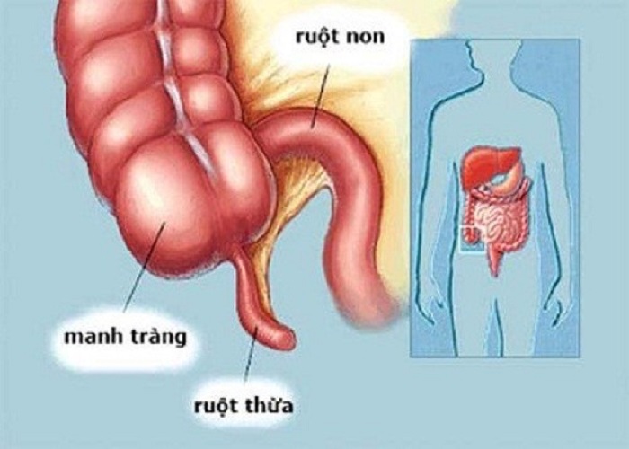 Vị trí của ruột thừa