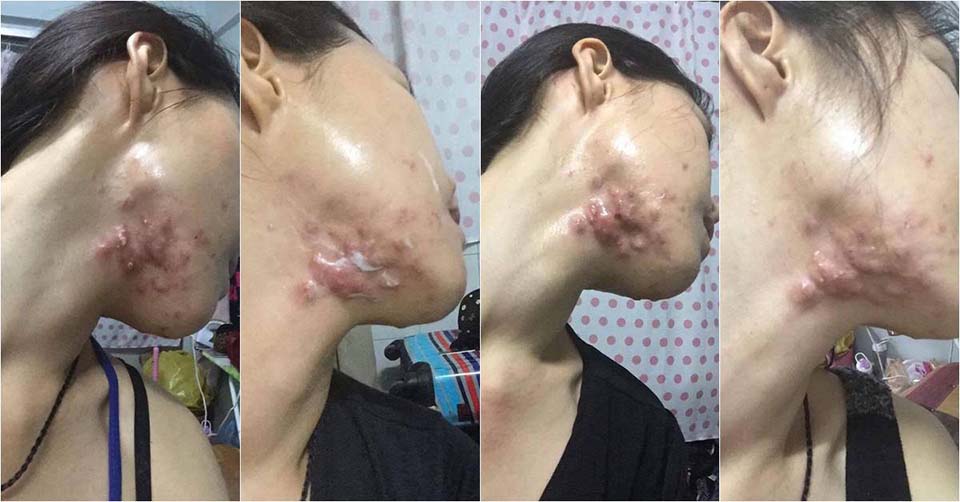 Berof Skincare Acne Treatment Lahore