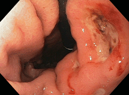 Peptic Ulcer Photograph