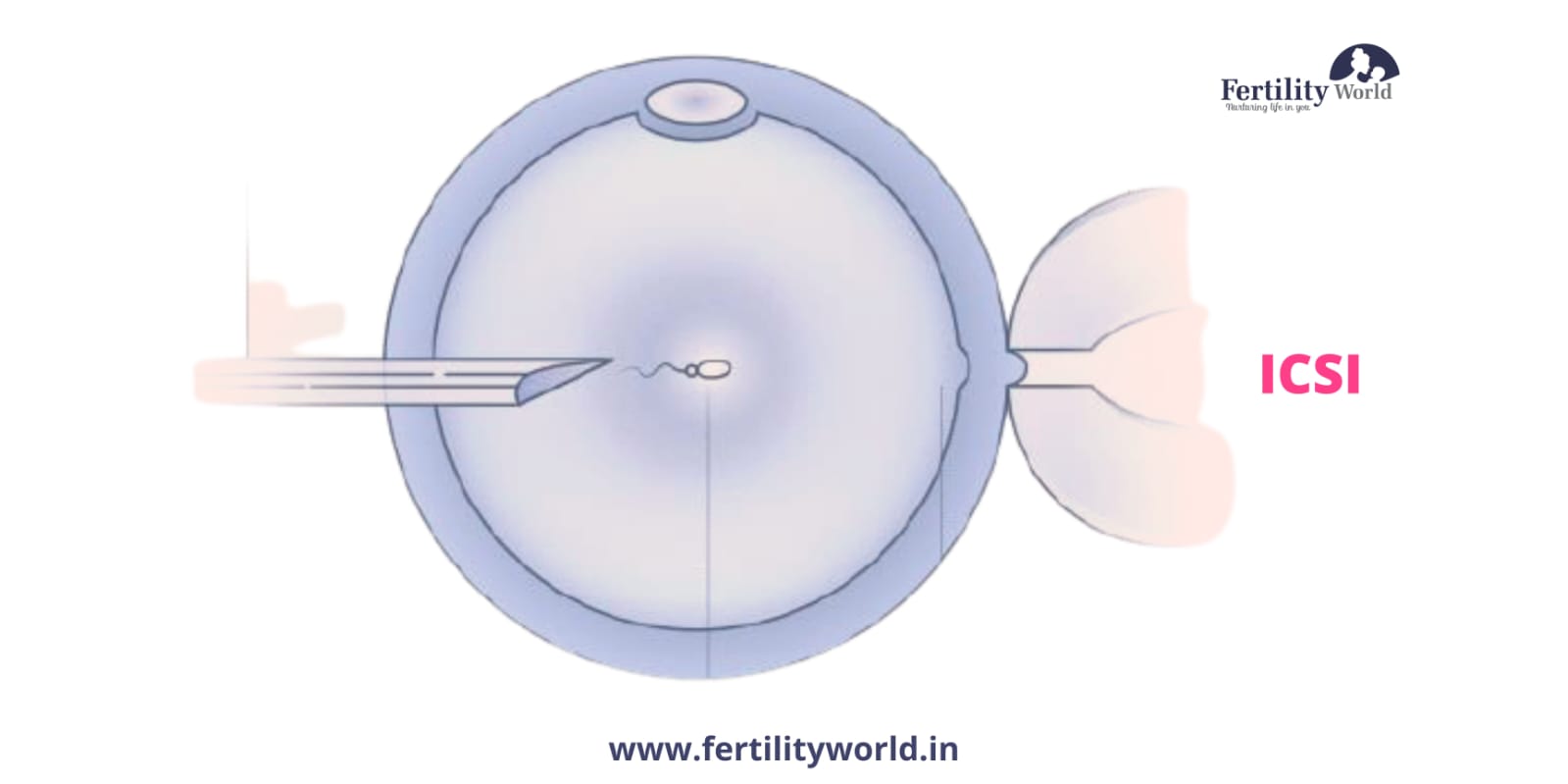 Cost of Intracytoplasmic sperm injection (ICSI) in Philippines