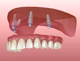 illustration showing upper denture being attached to upper jaw with four dental implants, implant dentures New Baltimore, MI