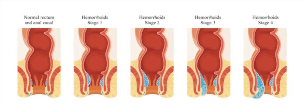 hemorrhoid-stages