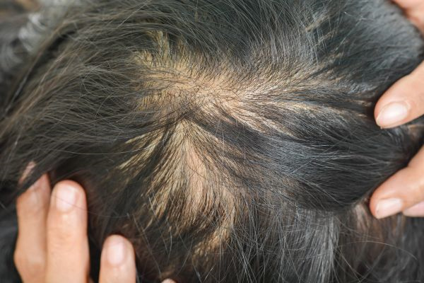 Female Pattern Hair loss - Thinning hair on top of head