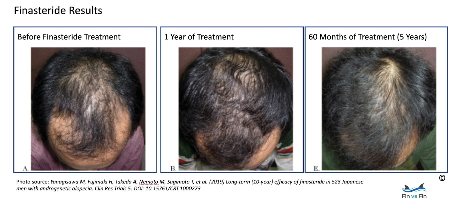 Finasteride Results: How Effective is it for Men's Hair Loss? - Fin vs Fin