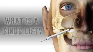 Image result for sinus lift
