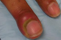Skin infection pictures and treatments
