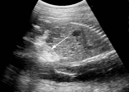 Injection of procaine penicillin G into the caudal abdomen of an equine fetus (arrow indicates hyperechoic location of injected PPG). In this case fetal death was not induced subsequent to the injection and a second injection was necessary to induce fetal death.