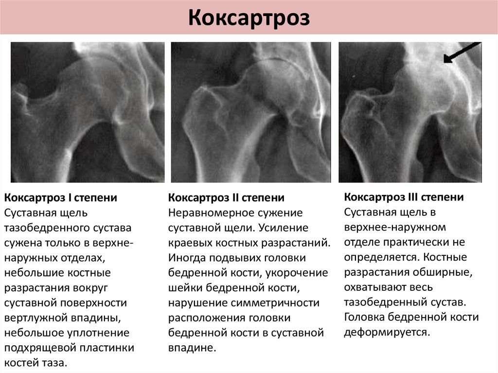 Артроз операция тазобедренного сустава