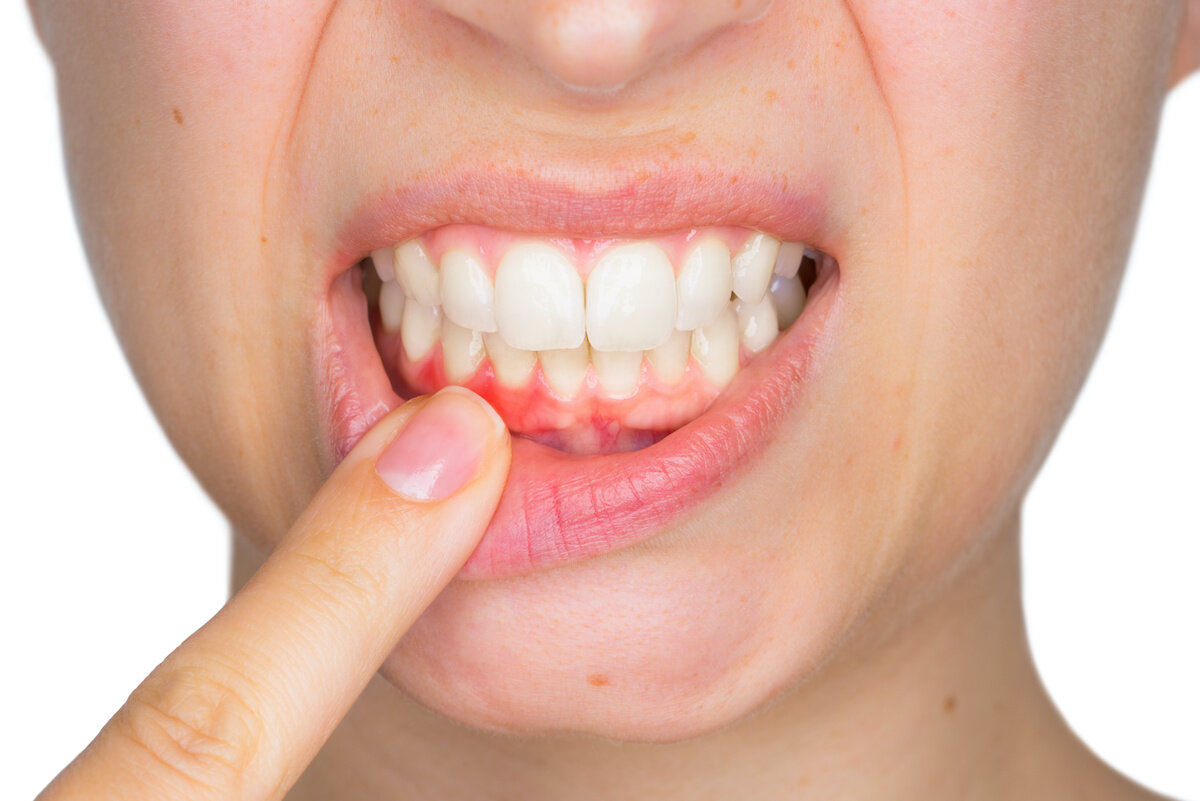 Does Gum Disease Go Away When Teeth Are Removed