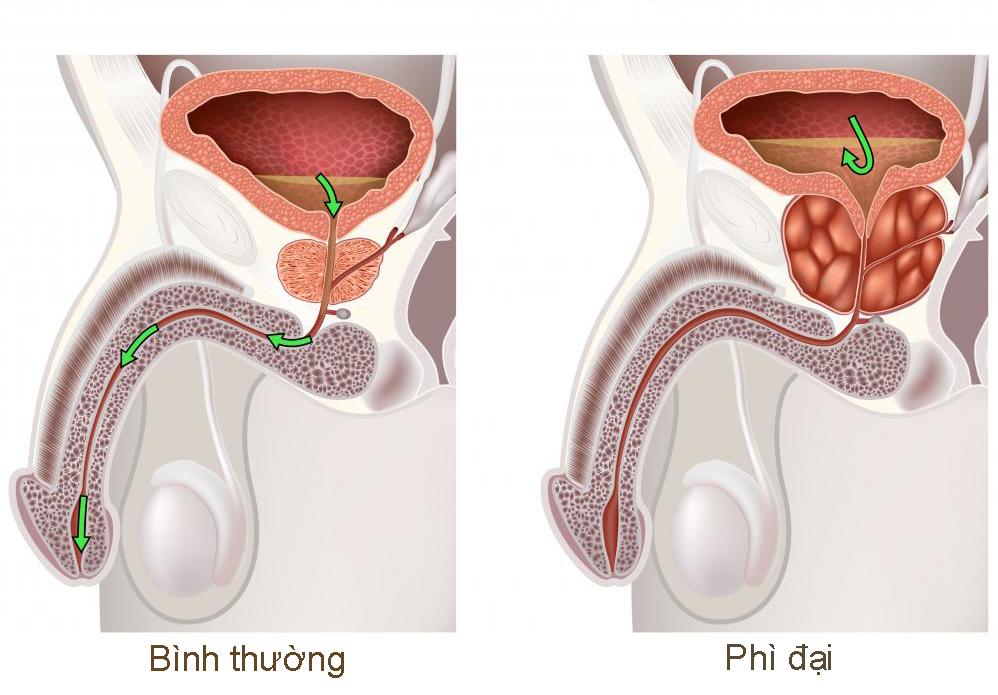 Giải pháp khắc phục phì đại tuyến tiền liệt