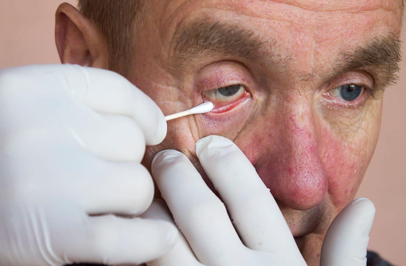 A close-up of a mature man wearing latex gloves on both hands is applying an eye ointment to cure pink eye.