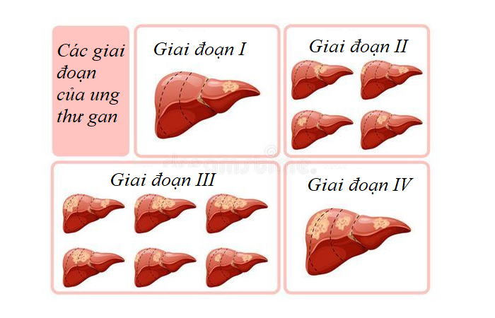 Ung thư gan được chia thành 4 giai đoạn: