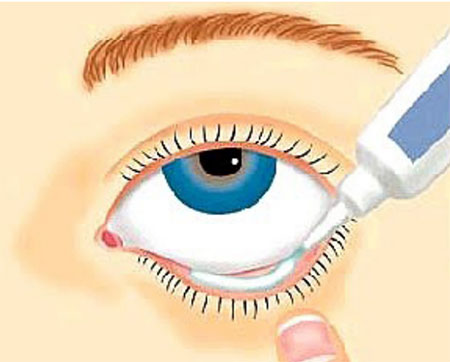 an illustration of someone applying eye ointment to their water line to treat dry eye