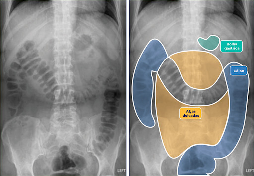 Radiografia do abdome na incidência anteroposterior (decúbito dorsal).