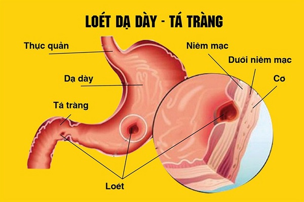 mo-ta-viem-loet-da-day-ta-trang-bang-hinh-anh