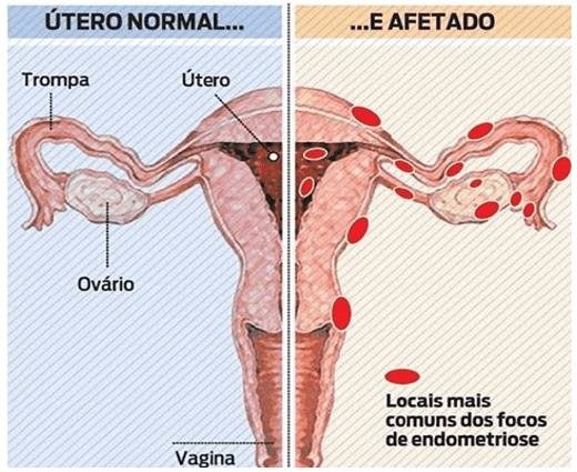 Útero normal e afetado por endometriose