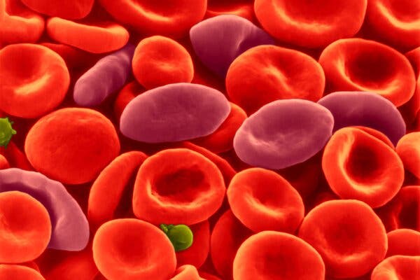 A scanning electron micrograph of sickle red blood cells (oblong, tapered cells in dark red) among healthy red blood cells.