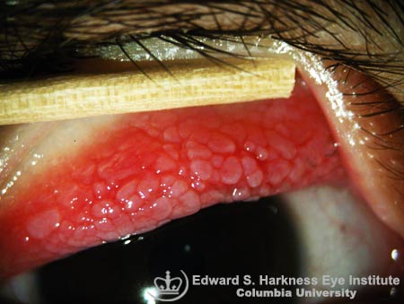 Steroid eye drops for episcleritis