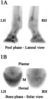 (A) Lateral pool phase scintigraphic images of the hind feet of Case 3.  
(B) Solar bone phase scintigraphic images of the hind feet in Case 3.