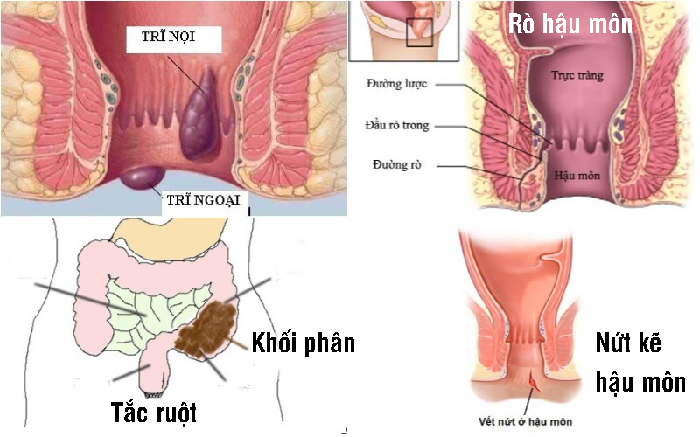 Táo bón kéo dài gây hậu quả nghiêm trọng